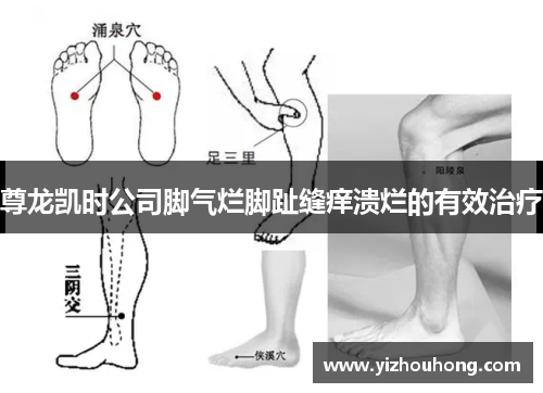 尊龙凯时公司脚气烂脚趾缝痒溃烂的有效治疗